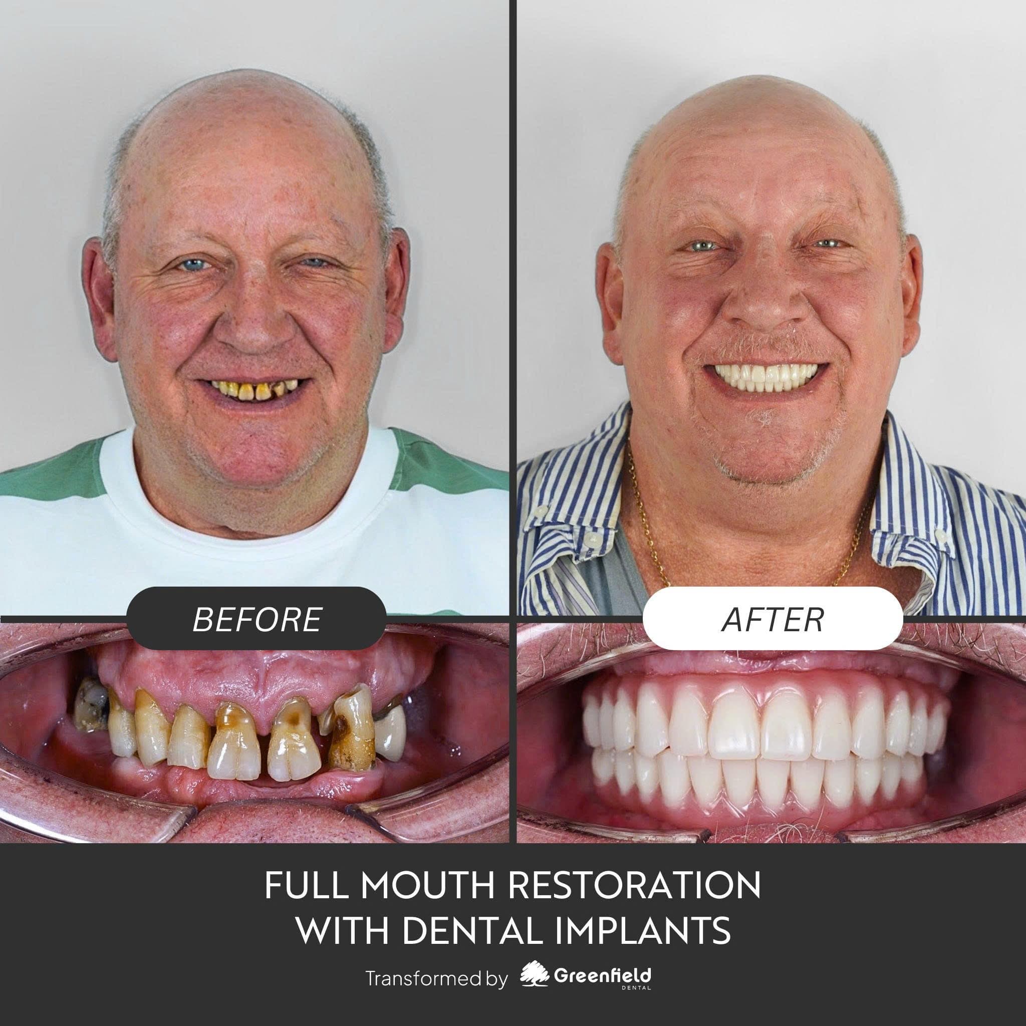 Phục hình toàn hàm với cấy ghép implant tại Greenfield Dental