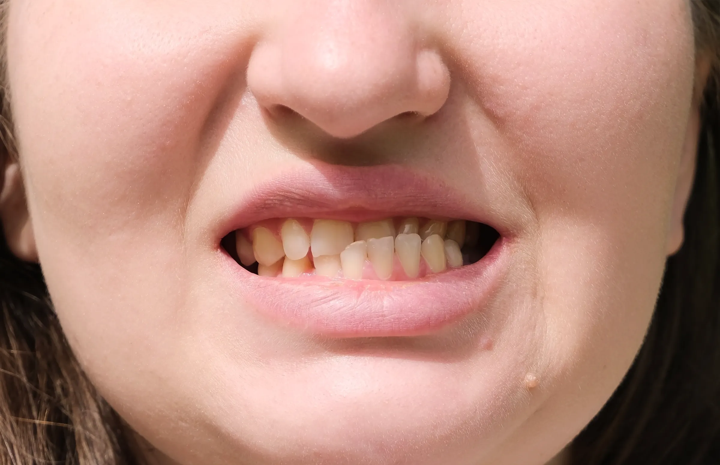 Mất cân đối hàm và khuôn mặt