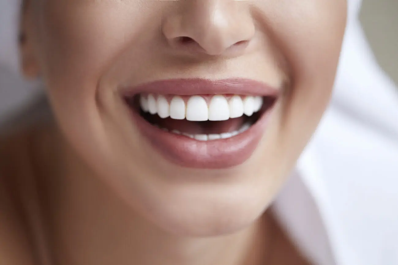 Mặt Dán Sứ Veneer