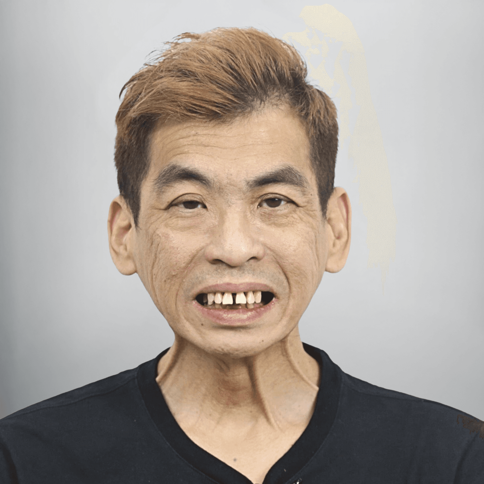Implant - Trước