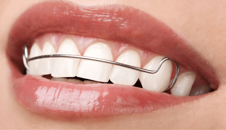 Liệu Khí Cụ Giữ Răng Có Bền Mãi Không? Mẹo Bảo Trì và Thay Thế