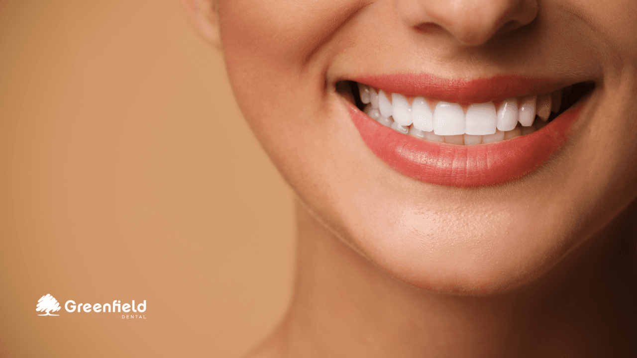 Có Cần Mài Giảm Răng Để Gắn Sứng Veneer? Những Sai Lầm So Với Sự Thật