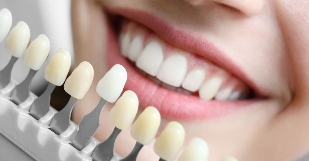 Nên Tẩy Trắng Răng Tại Nhà Hay Tại Nha Khoa?
