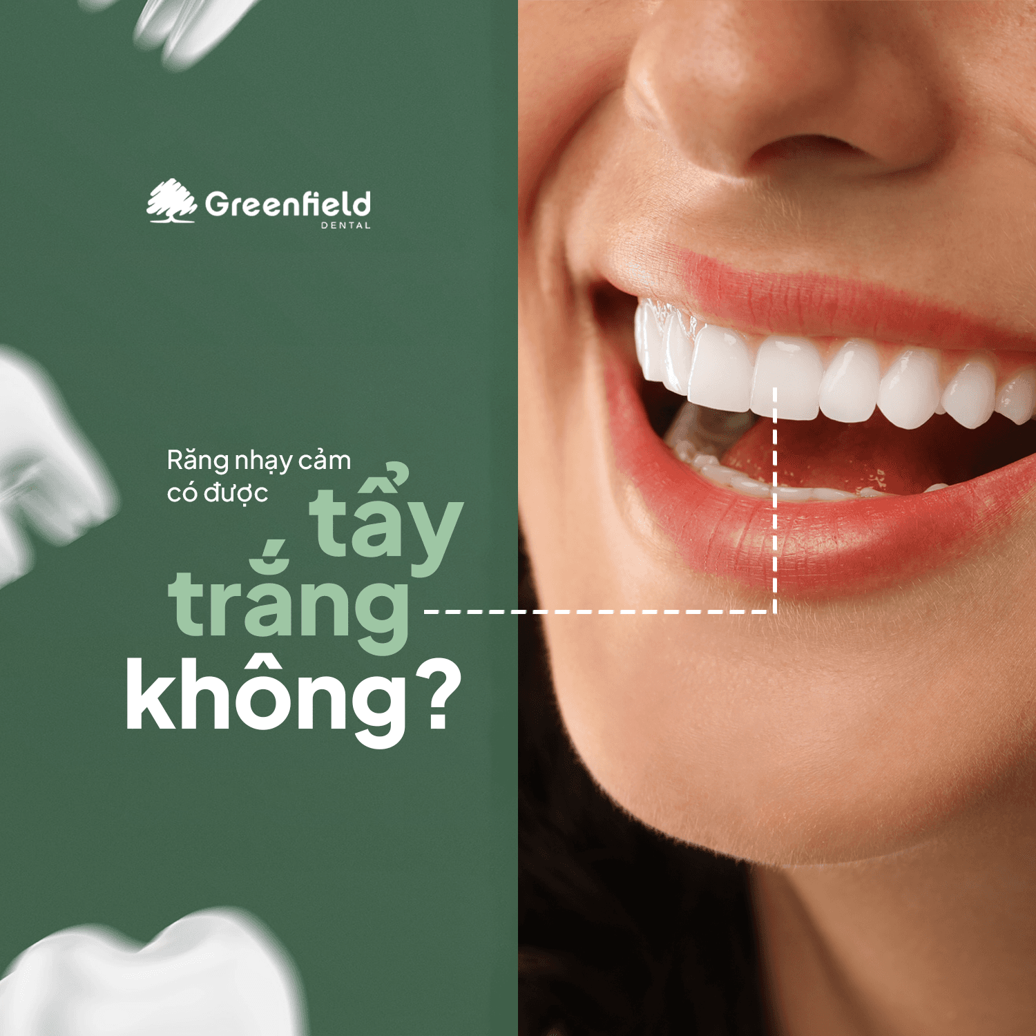 Răng Nhạy Cảm Có Nên Tẩy Trắng Răng Không?