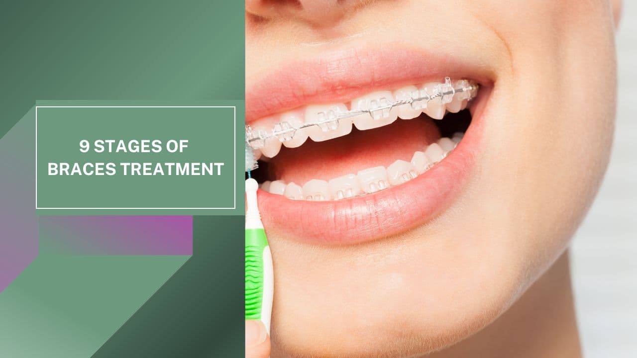 9 Giai Đoạn Chi Tiết Của Quá Trình Niềng Răng